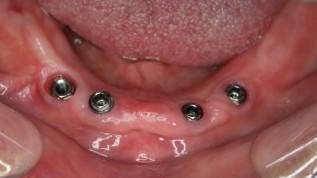 Sicheres Einkleben von Attachments