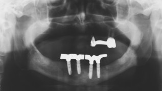 Indikation für die Periimplantitistherapie
