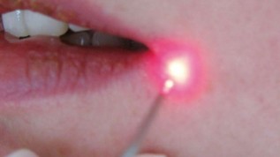 Herpes-Therapie mit dem Diodenlaser