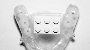 Schablonengestützte navigierte ­Implantation
