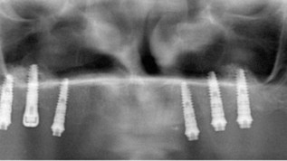 CAD/CAM-basierte Versorgung ­eines zahnlosen OK