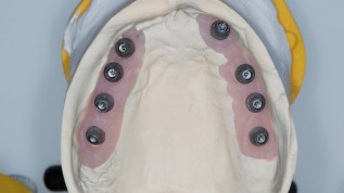 CAD/CAM- gefertigte Gerüste