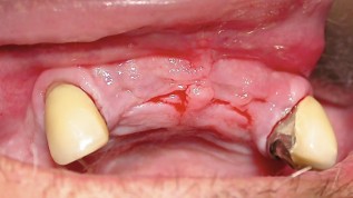 Nasenbodenlifting in der enossalen Implantologie