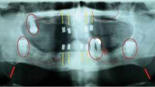 Implantatprothetische Rehabilitation ­