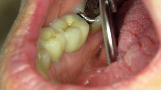 Periimplantäre Entzündungen