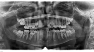 Frontzahntrauma bei jugendlichem Patient