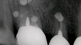 Endodontische Mikrochirurgie der apikalen Läsion