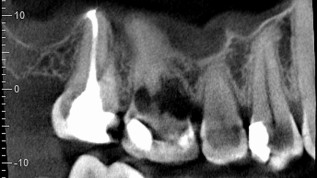 DVT in der Endodontie - Sinn oder Unsinn?
