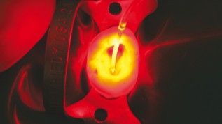 Photodynamische Therapie in der Endodontie