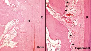 Corticision zur Beschleunigung von Zahnbewegungen