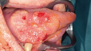 Diagnostik, Therapie des Plattenepithelkarzinoms