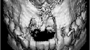 Prothetisch orientierte 3-D-Implantatplanung