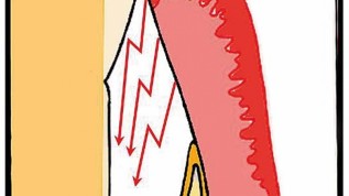 KFO-Therapie nach ­parodontaler Regeneration