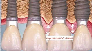 Improved aesthetics in full-arch restoration