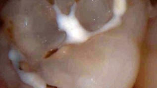 Kariesdiagnostik ohne ionisierende Strahlung