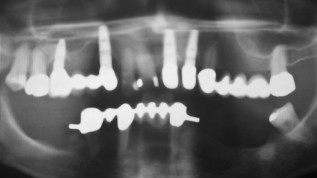Restauration mittels DVT und CAD/CAM