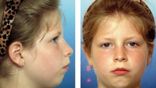 Diagnose und Therapie sagittaler Diskrepanzen