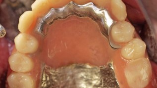 Implantatprothese beim atrophierten OK