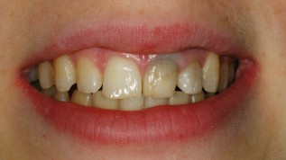 Therapie irreversibel verfärbter Zahnstümpfe