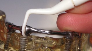 Langzeiterfolg von Implantatversorgungen
