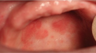 Mundhöhle und Lippen - Krebsfrüherkennung