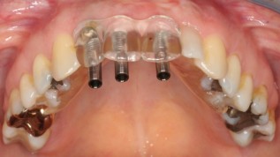 Virtuelle Implantatplanung im Vergleich