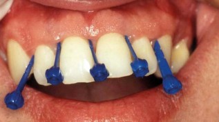 Parodontale Diagnostik und Therapie