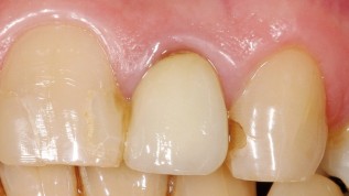 Postendodontische Versorgung