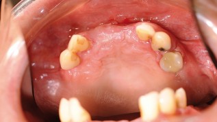 Minimalinvasive Implantologie