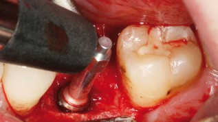 Beurteilung der Implantatstabilität