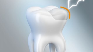DentalGlass Resist