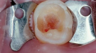 Milchzahnendodontie - State of the Art