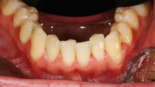 Perfektes Lächeln - mit minimalinvasiver Technik