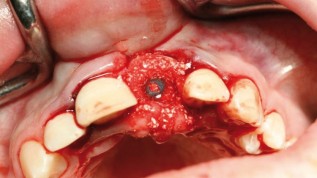 Membranen in der Kieferchirurgie