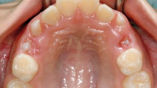 eCligner®-Behandlung beim jugendlichen Patienten
