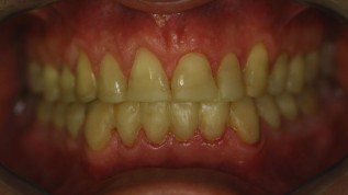 Rehabilitation einer stark erodierten Dentition