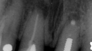Transgingival einheilende Implantate