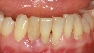 Parodontitis- und Periimplantitistherapie