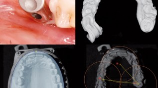 Vollkeramische Implantatversorgung leicht gemacht