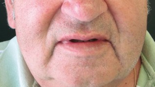 Versorgung eines zahnlosen Patienten