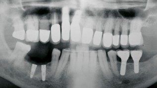 Abformung von Implantaten mit extremer Neigung
