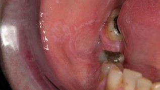 Oraler Lichen planus und orale lichenoide Reaktion