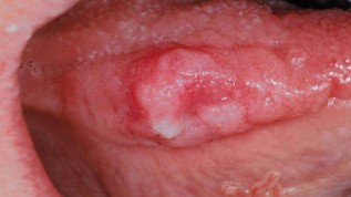 Leukoplakische Mundschleimhauterkrankungen