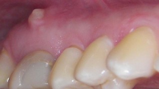 Lasereinsatz in endodontischen Szenarios