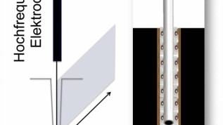 Das kombinierte Laser-Hochfrequenzgerät im Einsatz