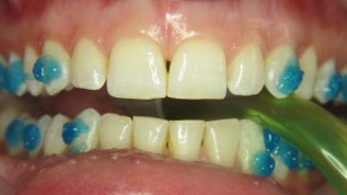 Herstellung von Invisalign®-Attachments mit SDR