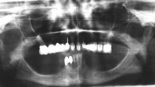 Minimalinvasiv trotz reduziertem Knochenangebot