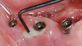 Die moderne Periimplantitisbehandlung