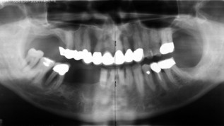 Erhöhung Alveolarkamm mit Distraktionsosteogenese