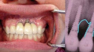 Erfolgreiche Periimplantitis-Prophylaxe